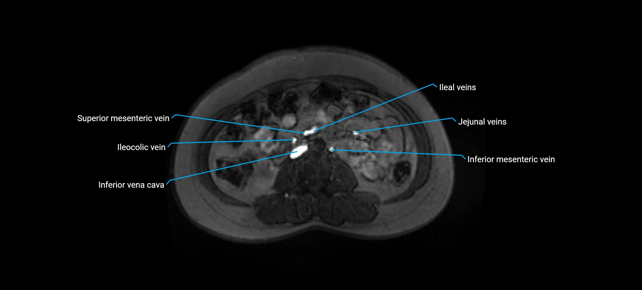 MRV abdomen pelvis & lower limb axial cross sectional anatomy labelled MRI image 91 (1).webp